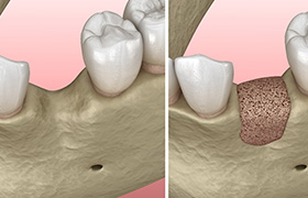 3D image of bone grafting in DeLand