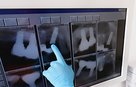 X-rays of teeth on computer screen