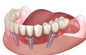 four dental implants in DeLand supporting an All-on-4 denture