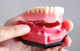 Dental implant dentist in DeLand holding a model of All-on-4 denture