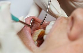 person getting a dental checkup