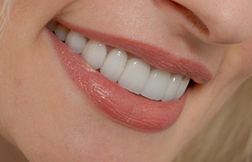 Closeup of flawless smile after dental bonding