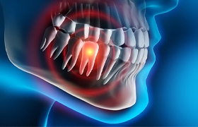 Painful tooth needing an emergency dentist in DeLand.