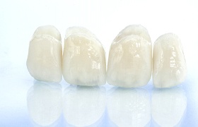 All-ceramic dental bridge in Deland