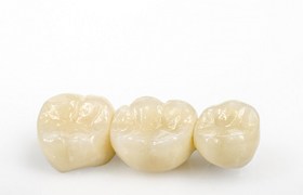 Porcelain dental bridge and crowns