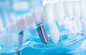 Dental implants in DeLand inside of a dental model