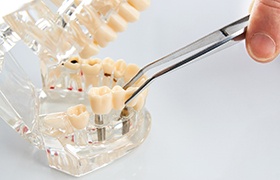Dental implant dentist in DeLand placing a restoration onto dental implants