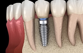 Diagram of an integrated dental implant in DeLand