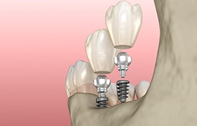 Diagram highlighting the components of dental implants in DeLand