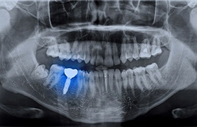X-ray showing an integrated dental implant in DeLand