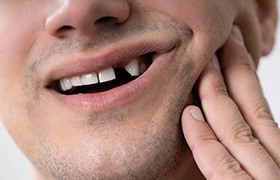 man smiling with missing tooth