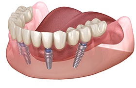 Graphic of implant dentures on white background