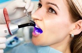 Dental bonding being light-cured 