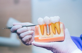 a dentist pointing to a model of a dental implant showing failure and salvage