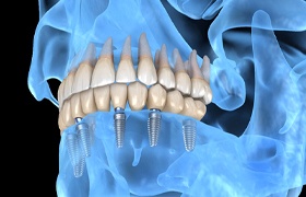 a computer illustration of a skull with a dental implant denture