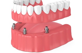 Illustration of dental implant dentures in DeLand, FL being placed