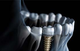 Digital illustration of dental implant in DeLand