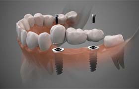 Digital illustration of dental implant bridge in DeLand