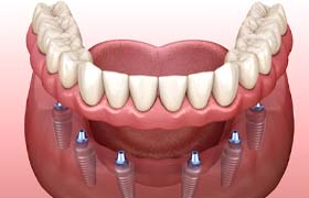 Digital illustration of dental implant dentures in DeLand