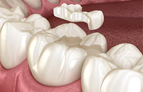 Animated smile during dental onlay placement