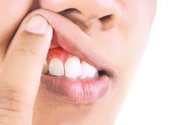 Inflamed gums before periodontal disease treatment
