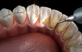 Animated smile during scaling and root planing treatment