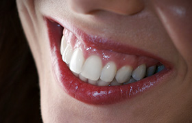 Closeup of healthy teeth and gums after periodontal therapy