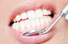 Closeup of healthy teeth and gums after periodontal therapy