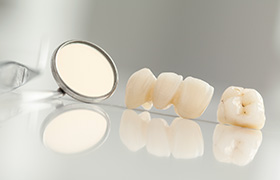 Dental crown and bridge prior to placement