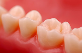 Teeth with natural looking tooth colored fillings