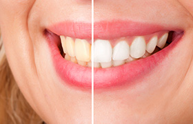 Closeup of smile half before and after teeth whitening