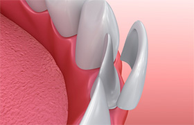 3D illustration of a porcelain veneer placement