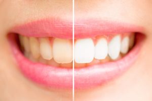 Woman's teeth half whitened.