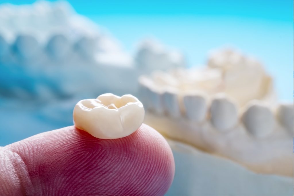 Loose Dental Crown DeLand, FL Christopher J. Cowell, DMD