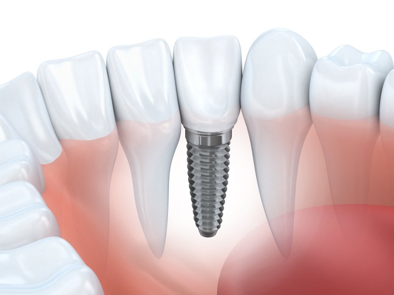 A single type implant, one of the types of dental implants