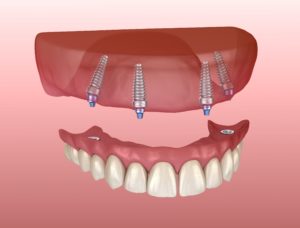 Implant denture for upper teeth